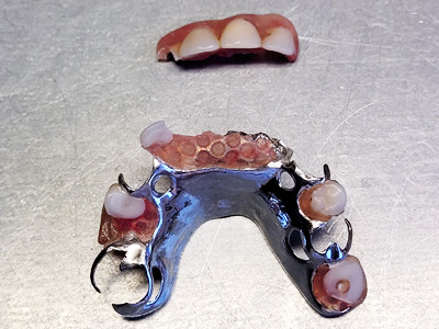 réparation prothèse dentaire à Floreffe